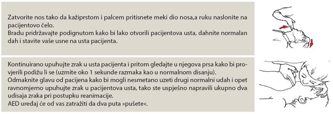 Kardiopulmonalna reanimacija